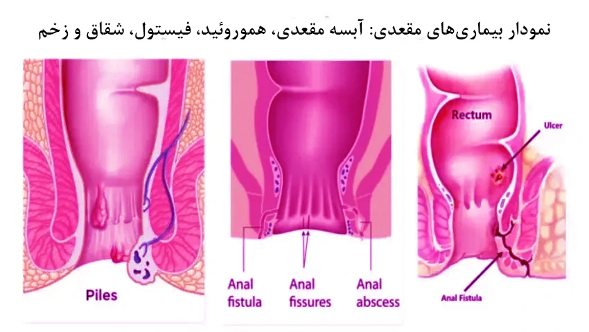 محل فیستول، شقاق و آبسه مقعدی و نحوه ایجاد مسیر فیستول (Fistula Tract)