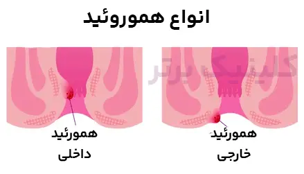 بواسیر (همورئید) داخلی و خارجی | کلینیک برتر