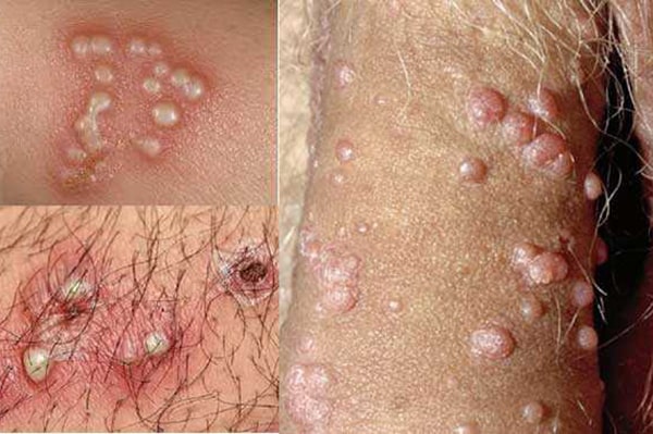 علل احتمالی ابتلا به زگیل تناسلی بدون رابطه جنسی