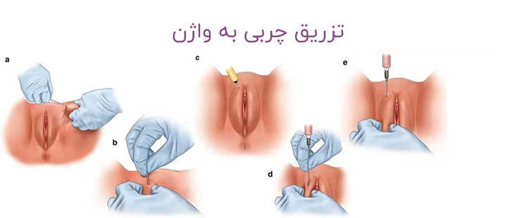 تزریق ژل به نقطه G