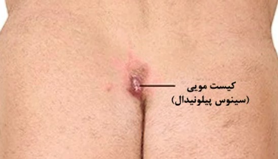 کیست مویی